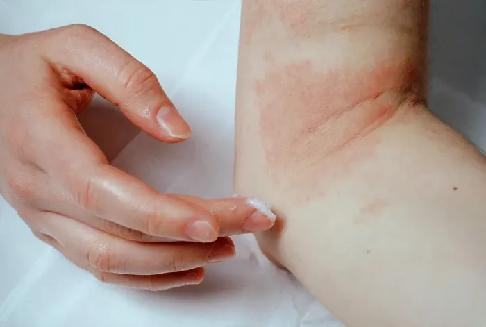 Framed Print : Woman applying ointment to eczema at the elbow, Germany, Europe