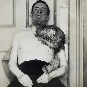 Bone cancer, malignant tumor, sarcoma