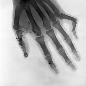 Bone of a hand, deformed little finger