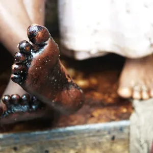 Boy showing oil soaked feet due to container ship chitra colliding in sea Bombay Mumbai Boy showing oil soaked feet due to container ship chitra colliding in sea Bombay Mumbai