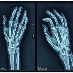 Hand X-ray of an adult female