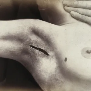 Patient, operation, an cut in the armpit to operation silverware