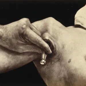 Patient, operation, a surgical instrument made of metal is inserted in an incision in the armpit