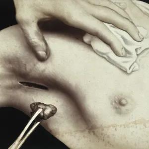 Patient, surgery, breast surgery