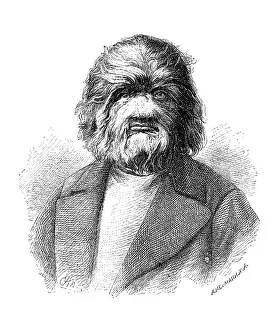 Adrian Yeftichev. A Russian man suffering from hypertrichosis