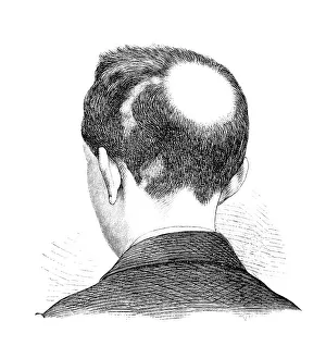 Alopecia areata (AA) is a condition affecting humans