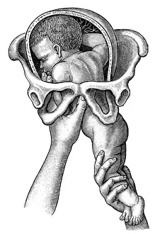 Birth, historical illustration from: Anna Fischer Dueckelmann