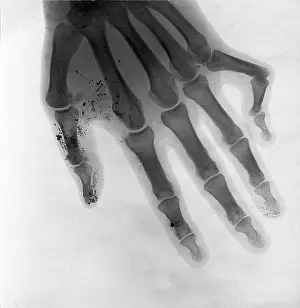 Bone of a hand, deformed little finger