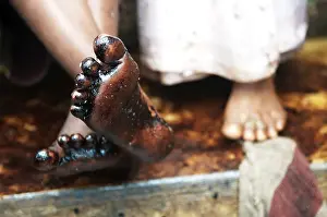 Boy showing oil soaked feet due to container ship chitra colliding in sea Bombay Mumbai