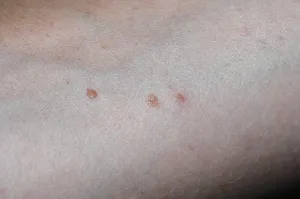 Flea bites