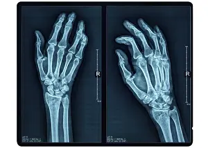 Hand X-ray of an adult female
