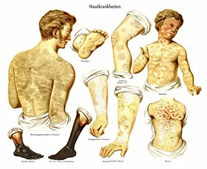 Historic illustration of skin diseases