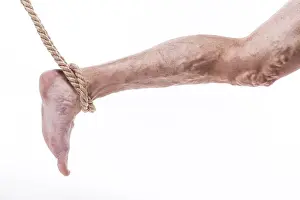 Human leg with blocked veins, thrombosis