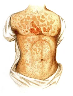 Measles, illustration, Meyers Konversations-Lexikon encyclopedia