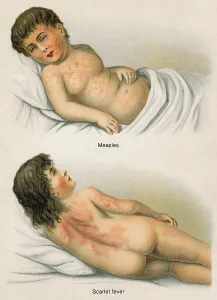 Measles, Scarlet fever, health counselor