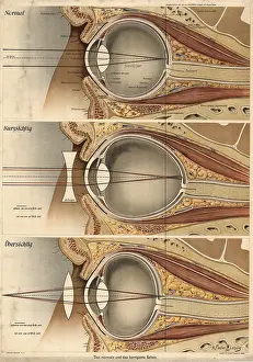 Medical illustration, defective vision of the human eye