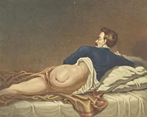 Medicine, Anatomy, Amputation of the Hip Joint in Military Surgery