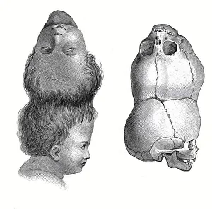 Medicine, Anatomy, Siamese twins