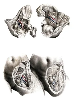 Medicine, human anatomy, femoral hernia