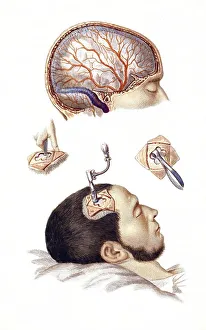 Medicine, Surgery, The trepanation