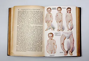 Rickets, deformed children, illustrations from the book