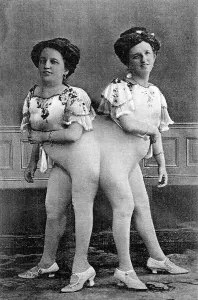 Siamese Twins, 1910s, Germany, Europe