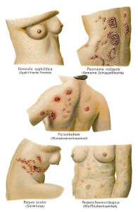 Skin diseases, 19th Century health guide illustration