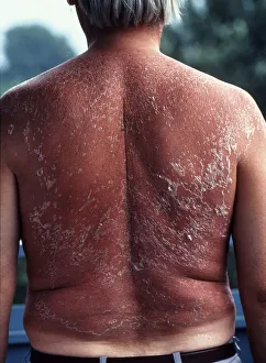 Back with sunburn, man, skin peeling
