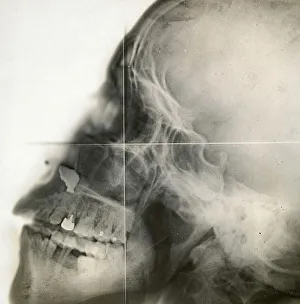X-ray of a human skull, c. 1915
